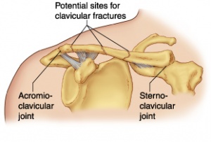 clavicularis-brachialis arthrosis