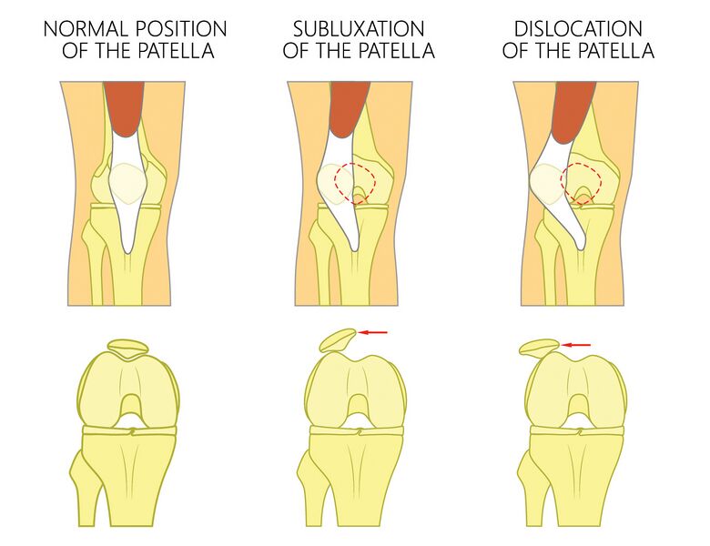 File:Patella Dislocation and Subluxation - Shutterstock Image - ID 637362388.jpg