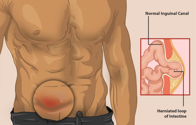 File:A Inguinal Hernia.png