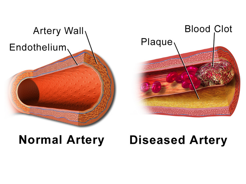 File:Artery Normal vs Diseased Vessel.png
