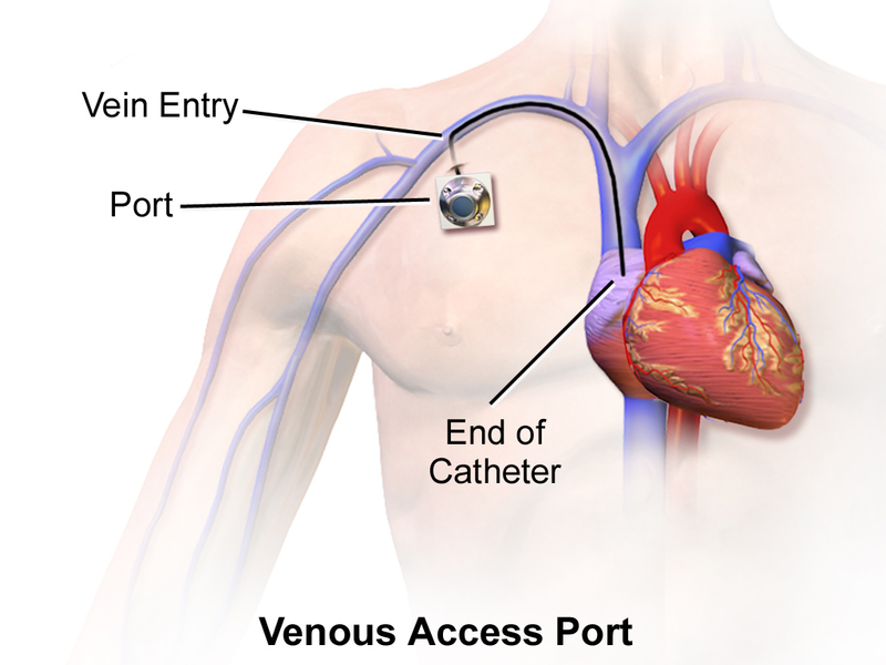 File:Port A Cath.png