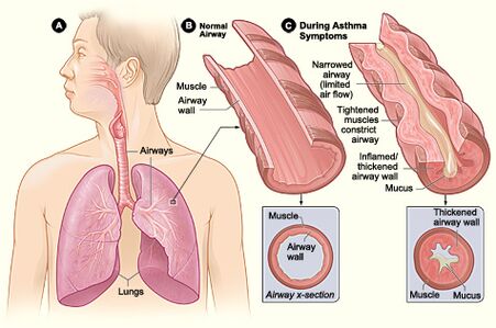 Asthma attack-illustration NIH.jpeg