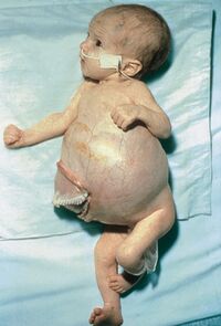 Neuroblastoma infant.jpeg