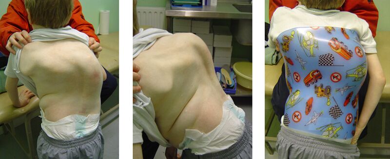 File:Neuromuscular Scoliosis - Donna's Own Images.jpg