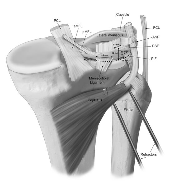 File:Posterior view of posterolateral attachments of lateral meniscus.jpeg