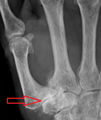 an xray image of OA of the first CMC joint