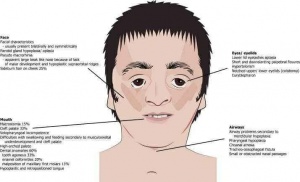 Treacher Collins Syndrome n (1).jpg