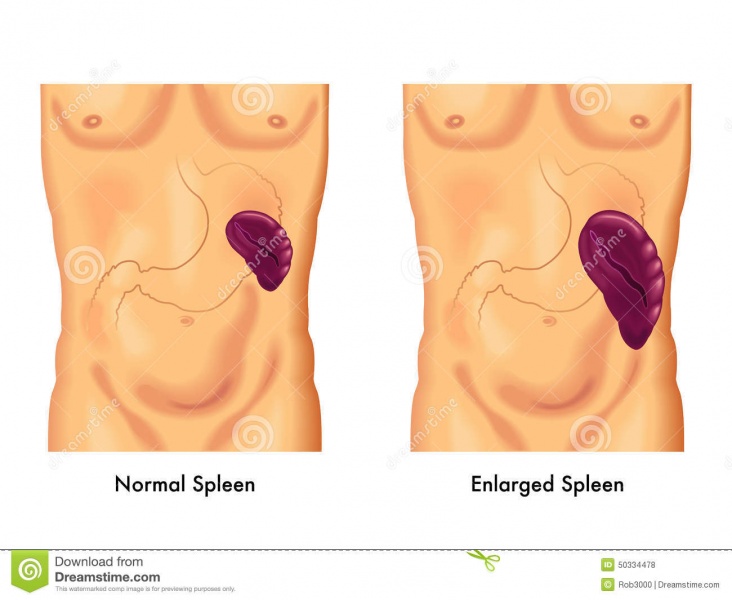 File:Enlarged-spleen-medical-illustration-symptoms-50334478.jpg
