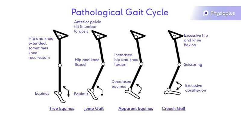 File:PAthalogical Gait cycle.jpg