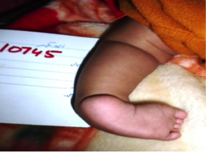 Case Study- Idiopathic Unilateral Clubfoot 2.png