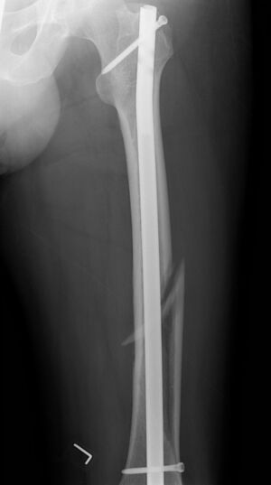 Cureus | Intertrochanteric Femoral Fractures: A Comparative Analysis of  Clinical and Radiographic Outcomes Between Talon Intramedullary Nail and  Intertan Nail | Article