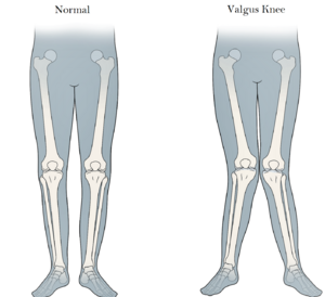 The difference between normal knee and valgus knee.png