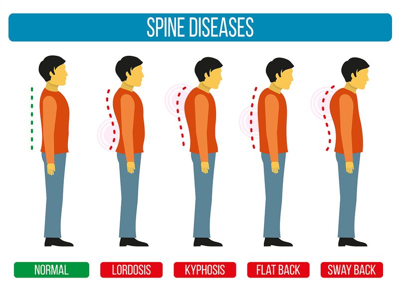 File:Adapted Bigstock Image - Spine Diseases - ID 129611492.jpg