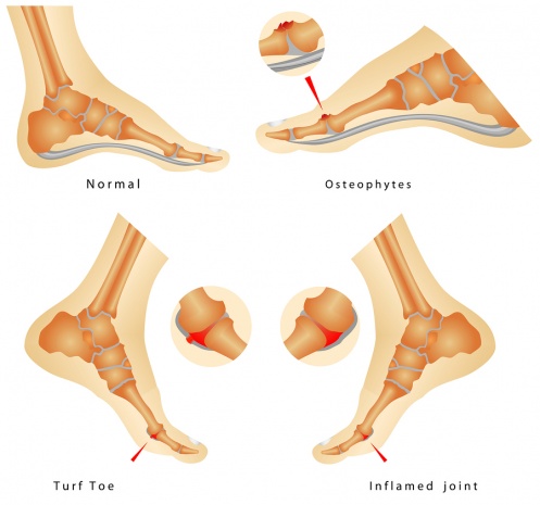 Møntvask galning Regnjakke Turf toe - Physiopedia
