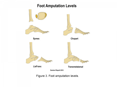 Foot amputation levels .png