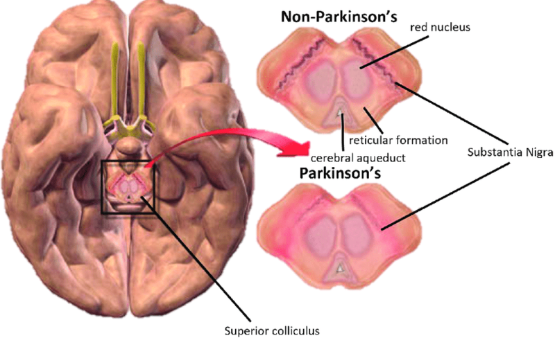 File:Parkinson's Disease Brain Comparison.png
