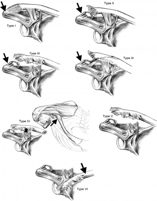Acromioclavicular Injury's according to Rockwood