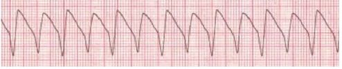 Ventricilular tachycardia.jpg