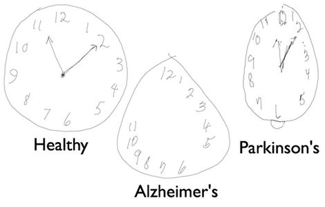 case studies on alzheimer's disease