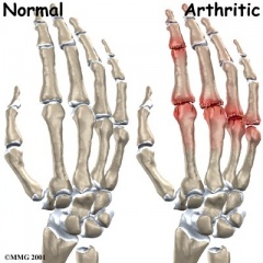 Finger arthritis.jpg
