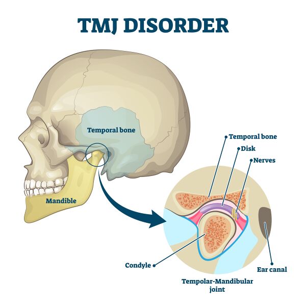 File:TMJ Disorder shutterstock 1716625330.jpeg