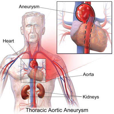 Thoracic Aortic Aneurysm.png