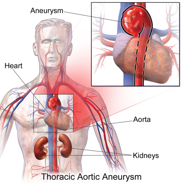 File:Thoracic Aortic Aneurysm.png