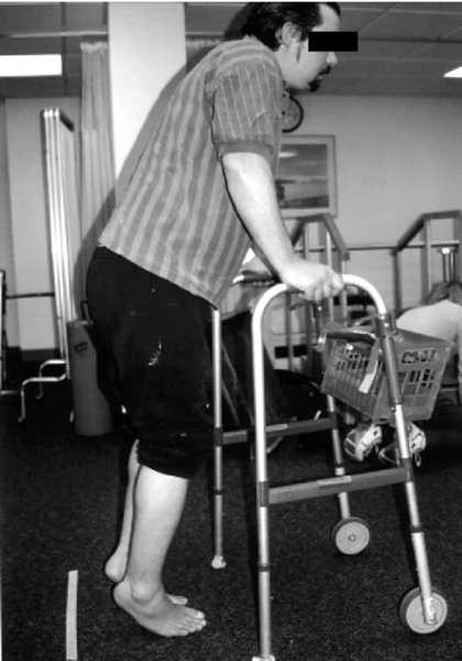 File:Stiff Person Syndrome Posture.png