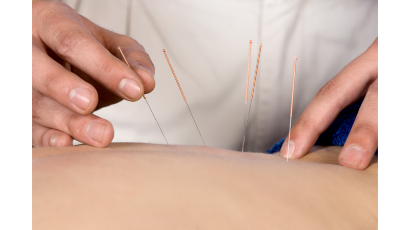 File:Integrative Medicine and Pain page - Photo credit Canva - Nanette Grebe - acupuncture.png