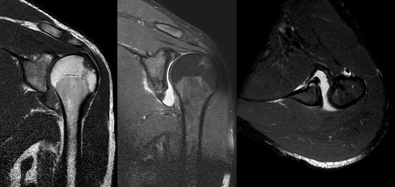 File:Post Dislocated shoulder MRI 01.png