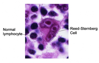 Reed-Sternberg cell.jpg