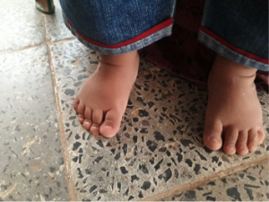 Case Study-Idiopathic Bilateral Clubfoot 4.png