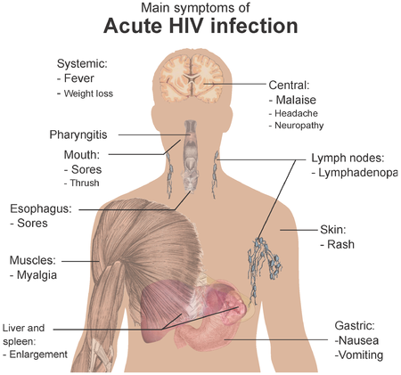 Symptoms of acute HIV infection.png
