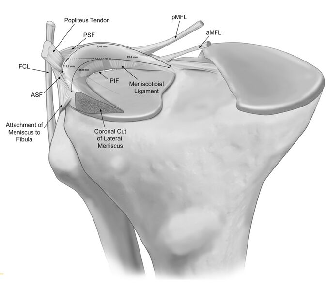 File:Anterior view of posterolateral attachments of lateral menicus.jpeg
