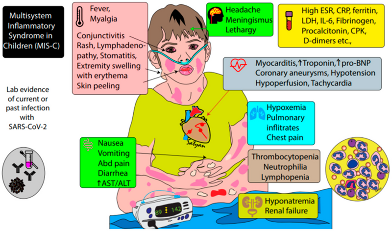 File:Multisysytem Inflammatory Syndrome in Children MIS-C.webp