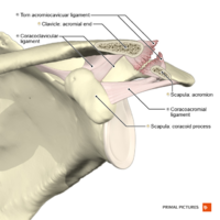 Acromioclavicular separation type 2 Primal.png