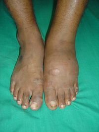 https://commons.wikimedia.org/wiki/File:Charcot_arthropathy_clinical_examination.jpg J. Terrence Jose Jerome, CC BY 3.0 <https://creativecommons.org/licenses/by/3.0>, via Wikimedia Commons