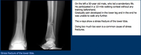 lucht Ruwe olie Kostuum Leg and Foot Stress Fractures - Physiopedia