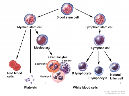 Acute Lymphoblastic Leukemia - Physiopedia