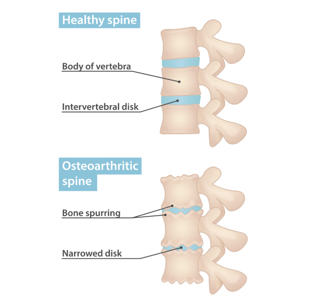 File:Osteoarthritic Spine (48605563867).png