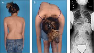 Scoliosis clinical presentation incl. x-ray