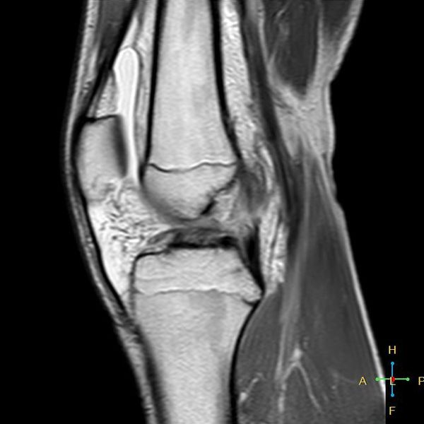 File:Anterior-cruciate-ligament-tear-complete-2.jpg