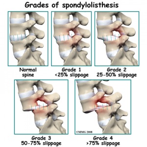 Lumbar spondylolisthesis grades.jpg