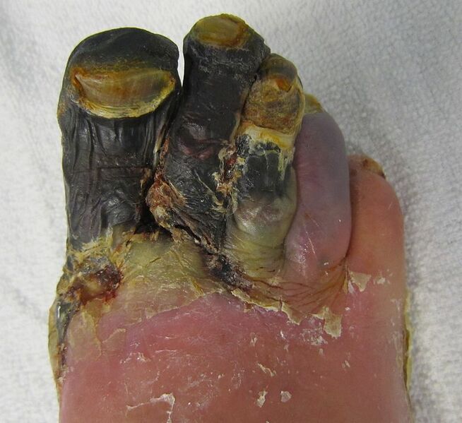 File:Dry Gangrene of the 1st to 4th Toe.jpg