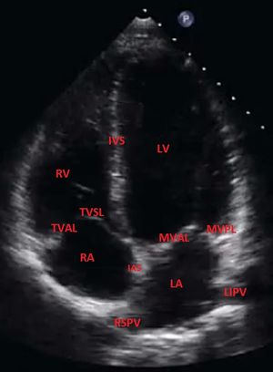 Apical-4-chamber-view-normal-transthoracic-echocardiography.jpeg
