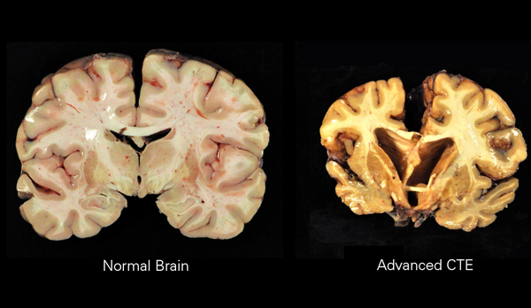 Atrophy caused by CTE.png
