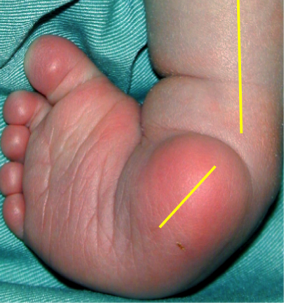File:Clubfoot8.png