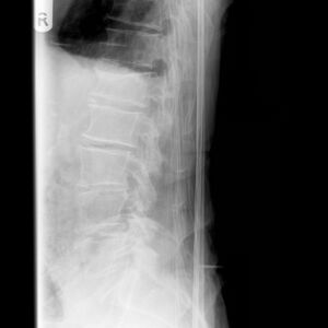Editing Osteoporotic Vertebral Fractures - Physiopedia
