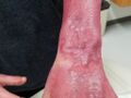 Resulting scars of a deep partial burn wound