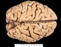 Note the raised sulci and depressed gyri forming surface of the cerebrum